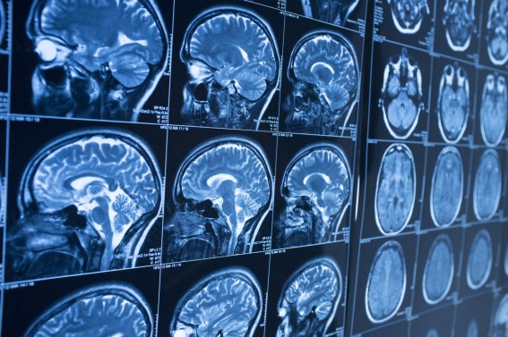 Head x-ray, brain in MRI